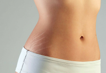 How To Get Rid Of Those Stubborn Stretch Marks