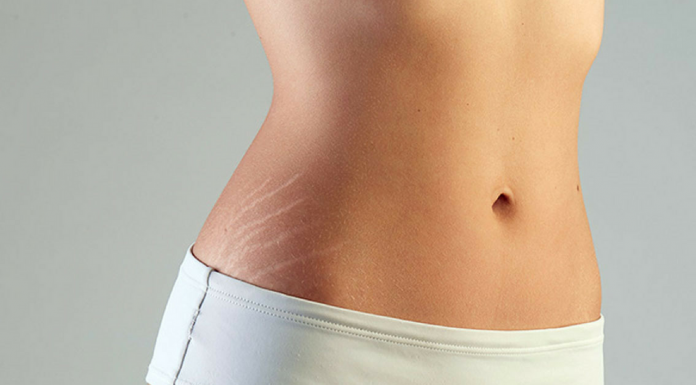 How To Get Rid Of Those Stubborn Stretch Marks